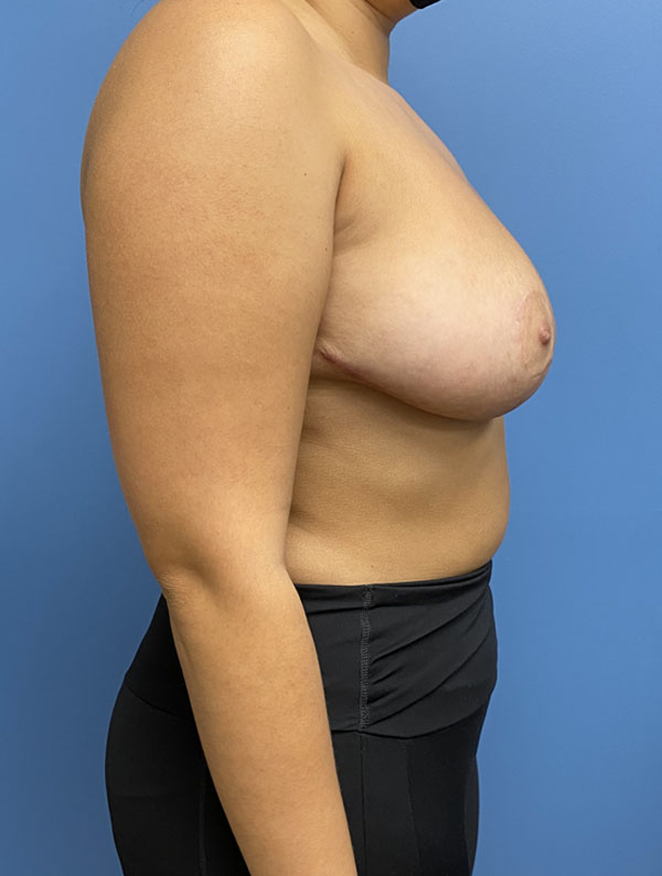 Breast Reduction case #2932