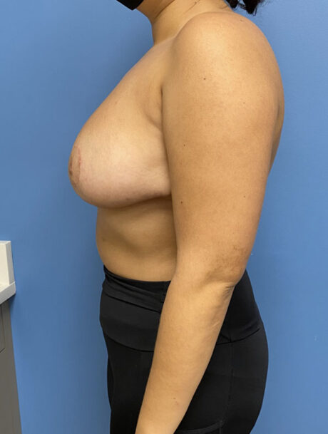 Breast Reduction case #2932