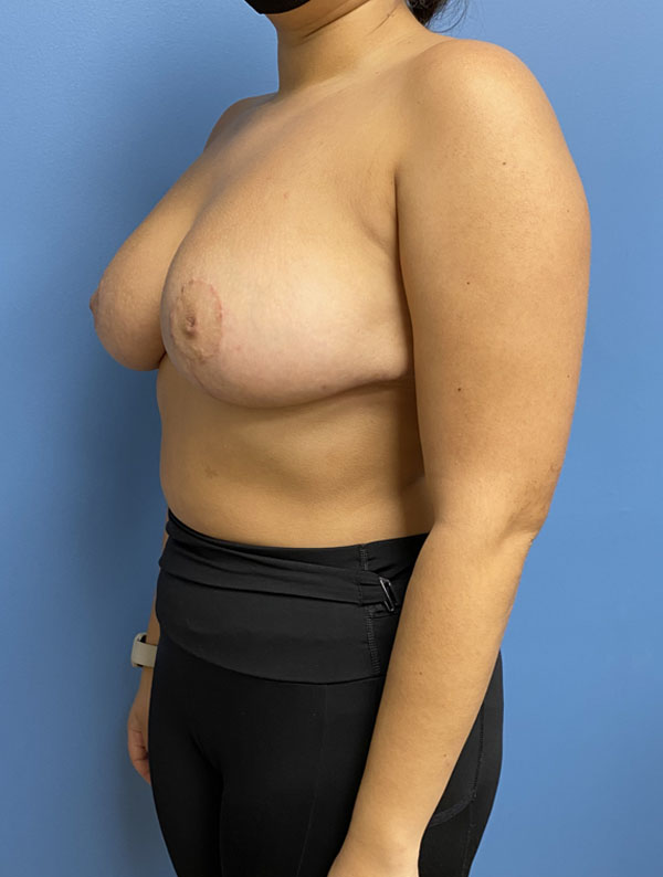 Breast Reduction case #2932