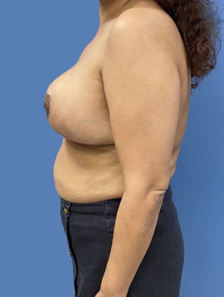 Breast Reduction case #2976