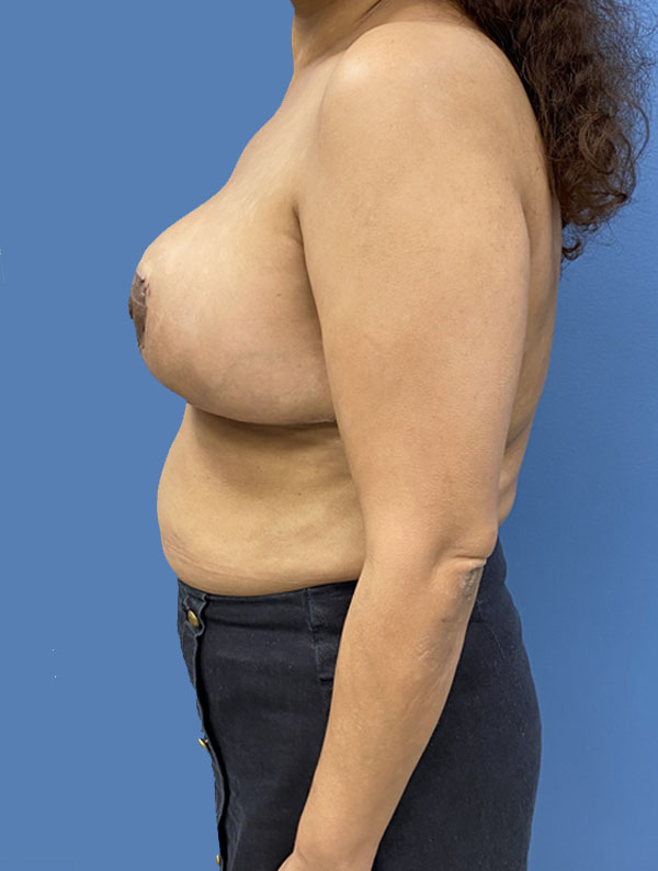Breast Reduction case #2976