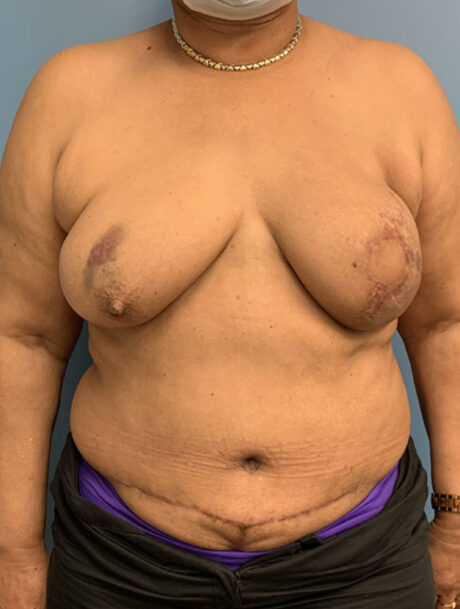 DIEP Flap case #2609