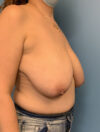 Breast Reduction case #2746
