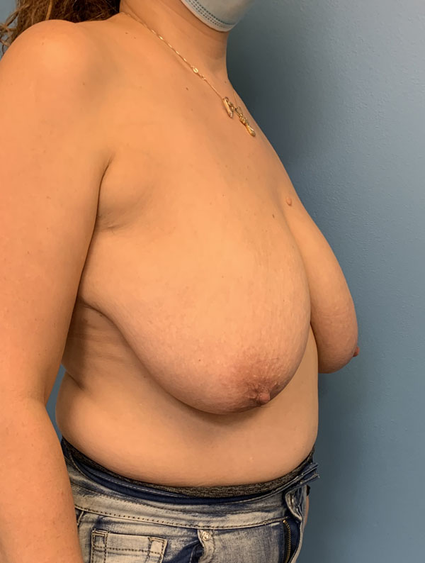 Breast Reduction case #2746