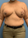 DIEP Flap case #2609