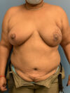 DIEP Flap case #2609