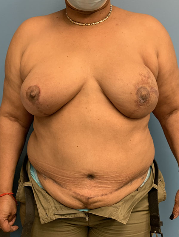 DIEP Flap case #2609