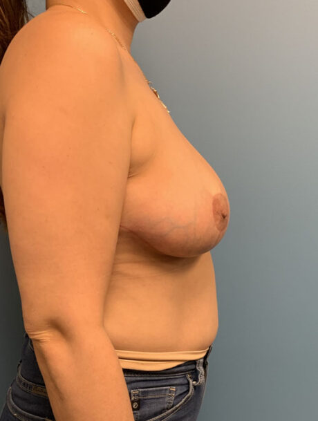 Breast Reduction case #2746