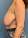 Breast Reduction case #2746