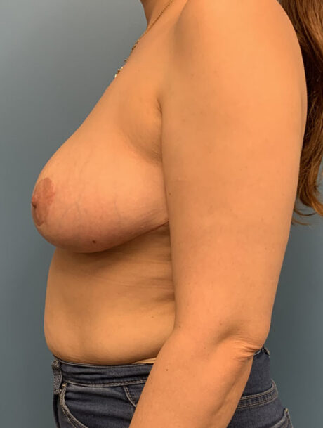 Breast Reduction case #2746