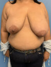 Oncoplastic Breast Reconstruction case #3010