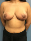 Breast Reduction case #2756