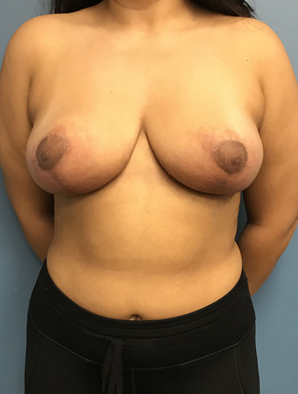 Breast Reduction case #2756