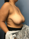 Breast Reduction case #2756