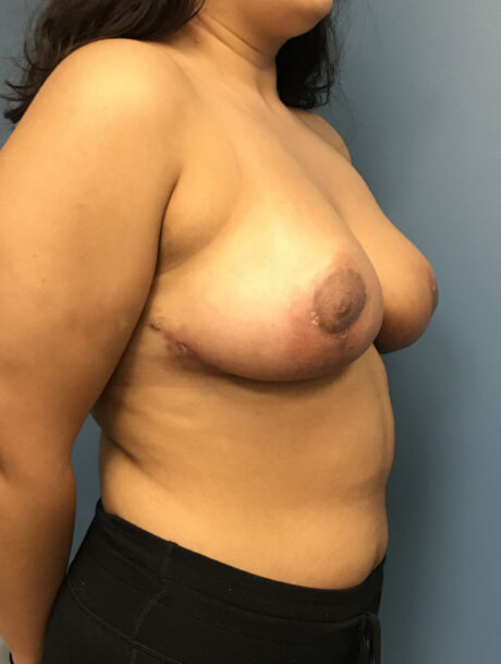 Breast Reduction case #2756