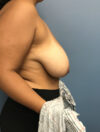 Breast Reduction case #2756
