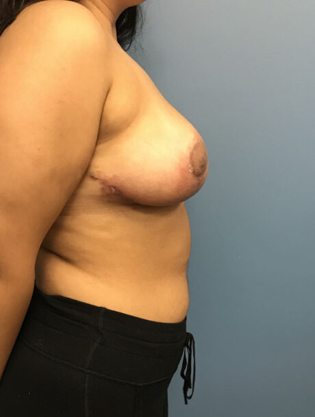 Breast Reduction case #2756
