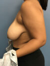 Breast Reduction case #2756