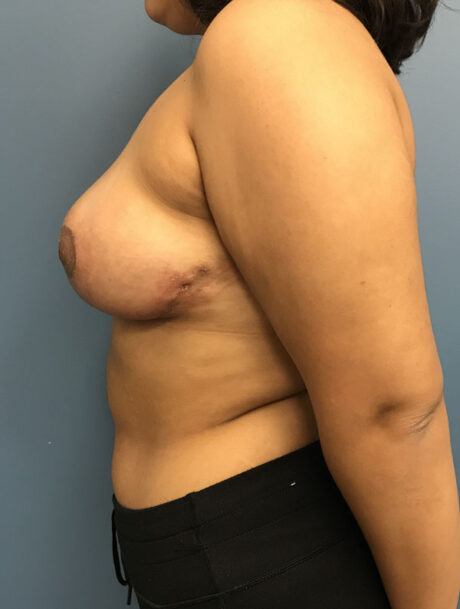 Breast Reduction case #2756