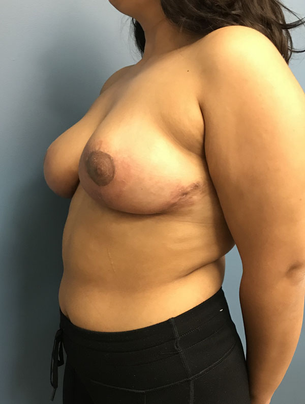 Breast Reduction case #2756