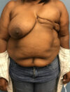 DIEP Flap case #2617
