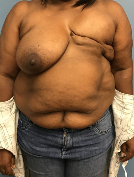 DIEP Flap case #2617
