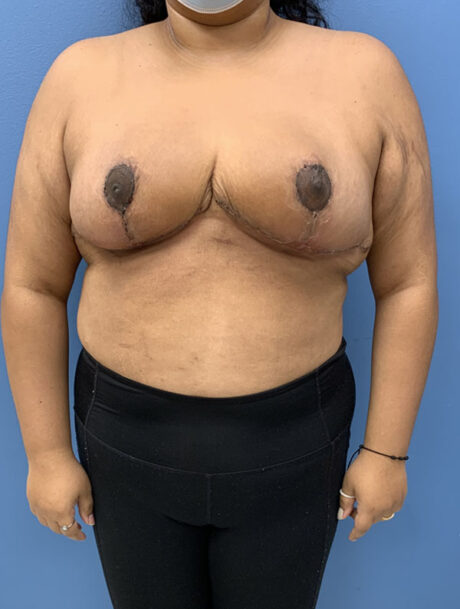 Breast Reduction case #2768