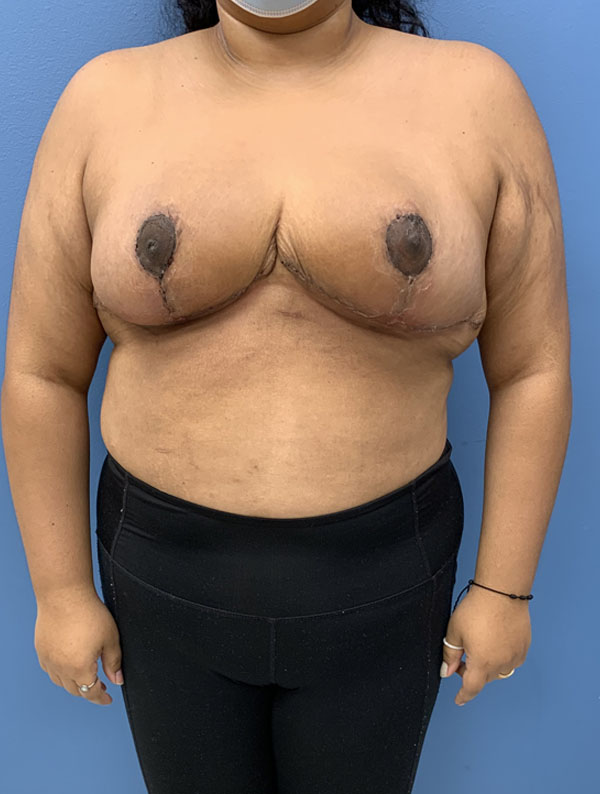 Breast Reduction case #2768