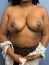 Oncoplastic Breast Reconstruction case #3012