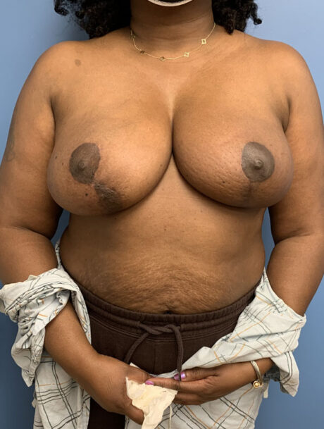 Oncoplastic Breast Reconstruction case #3012