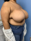 Breast Reduction case #2768