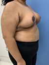 Breast Reduction case #2768