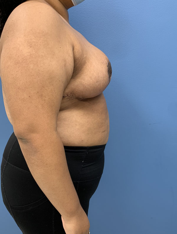 Breast Reduction case #2768