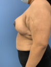 Breast Reduction case #2768