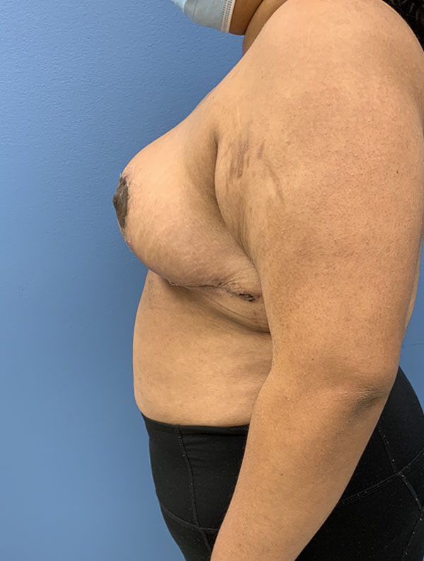 Breast Reduction case #2768
