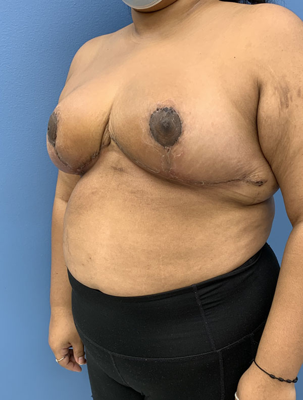 Breast Reduction case #2768