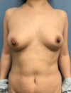 DIEP Flap case #2628