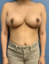 Breast Reduction case #2778