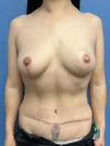 DIEP Flap case #2628