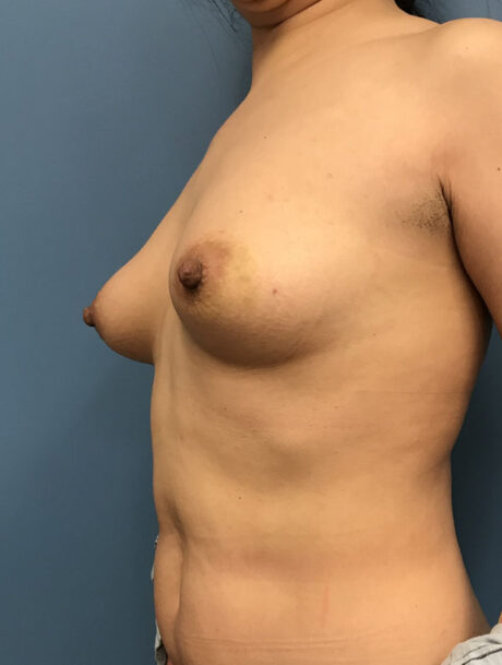 DIEP Flap case #2628