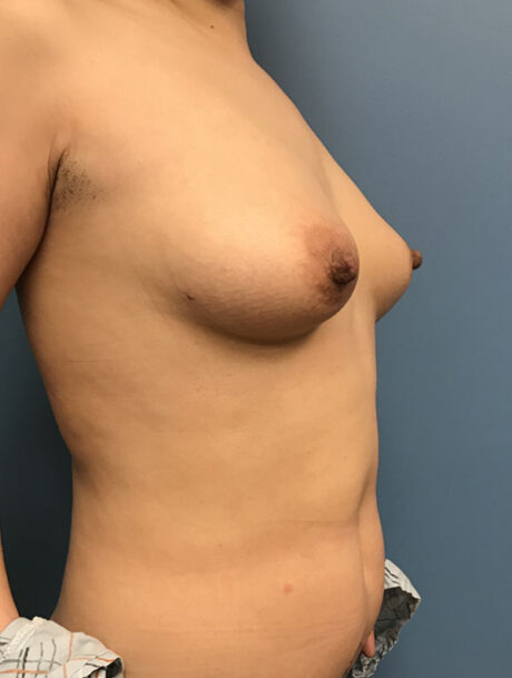 DIEP Flap case #2628