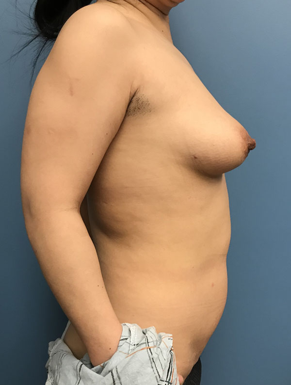 DIEP Flap case #2628