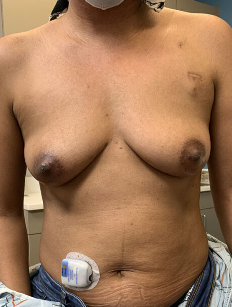 DIEP Flap case #2633