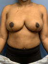 Breast Reduction case #2790