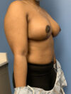 Breast Reduction case #2790