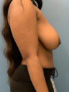 Breast Reduction case #2790