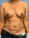 DIEP Flap case #2633
