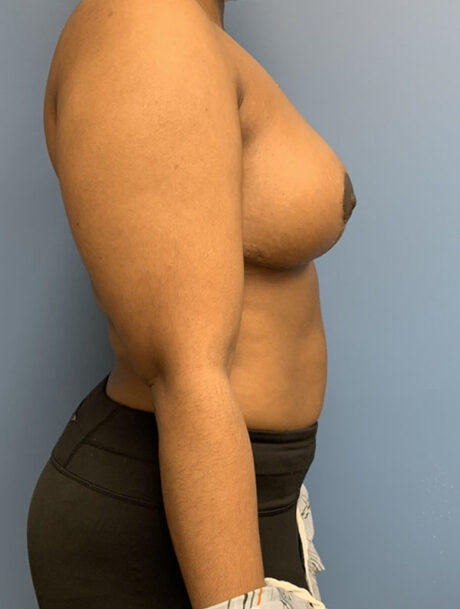 Breast Reduction case #2790