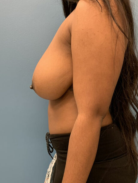 Breast Reduction case #2790