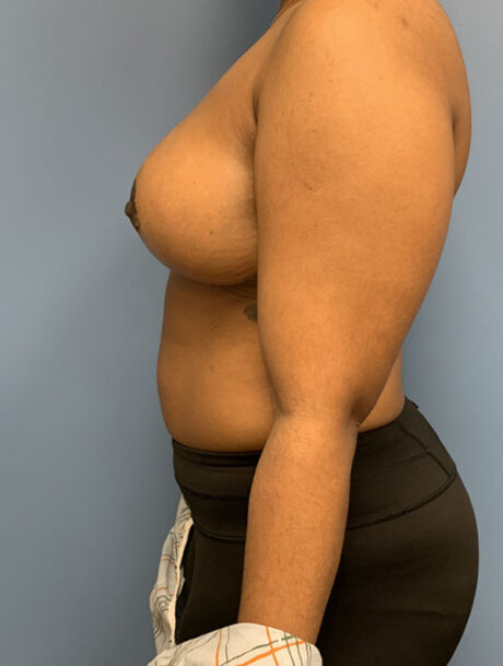 Breast Reduction case #2790